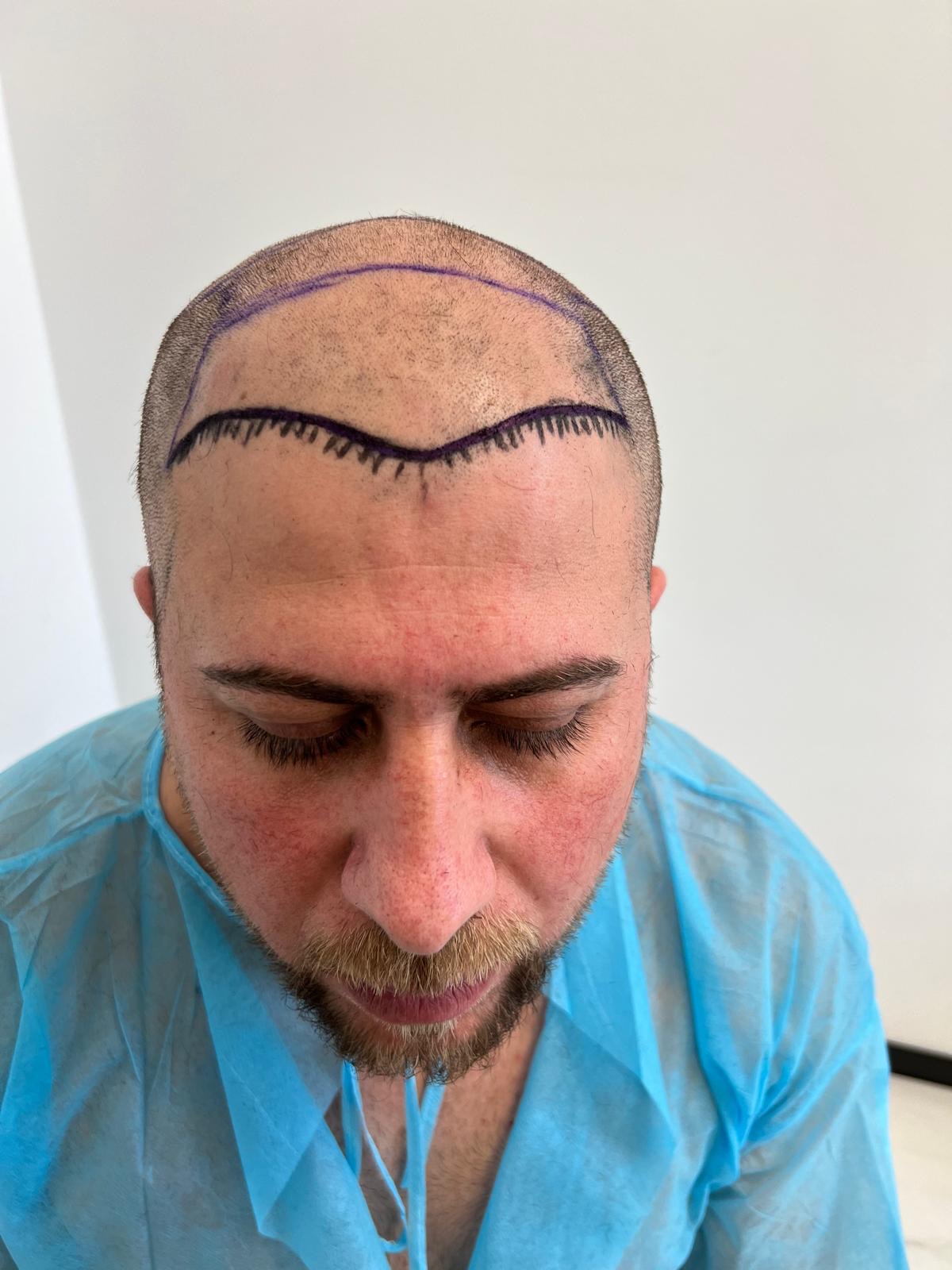 حالة 7 قبل زراعة الشعر