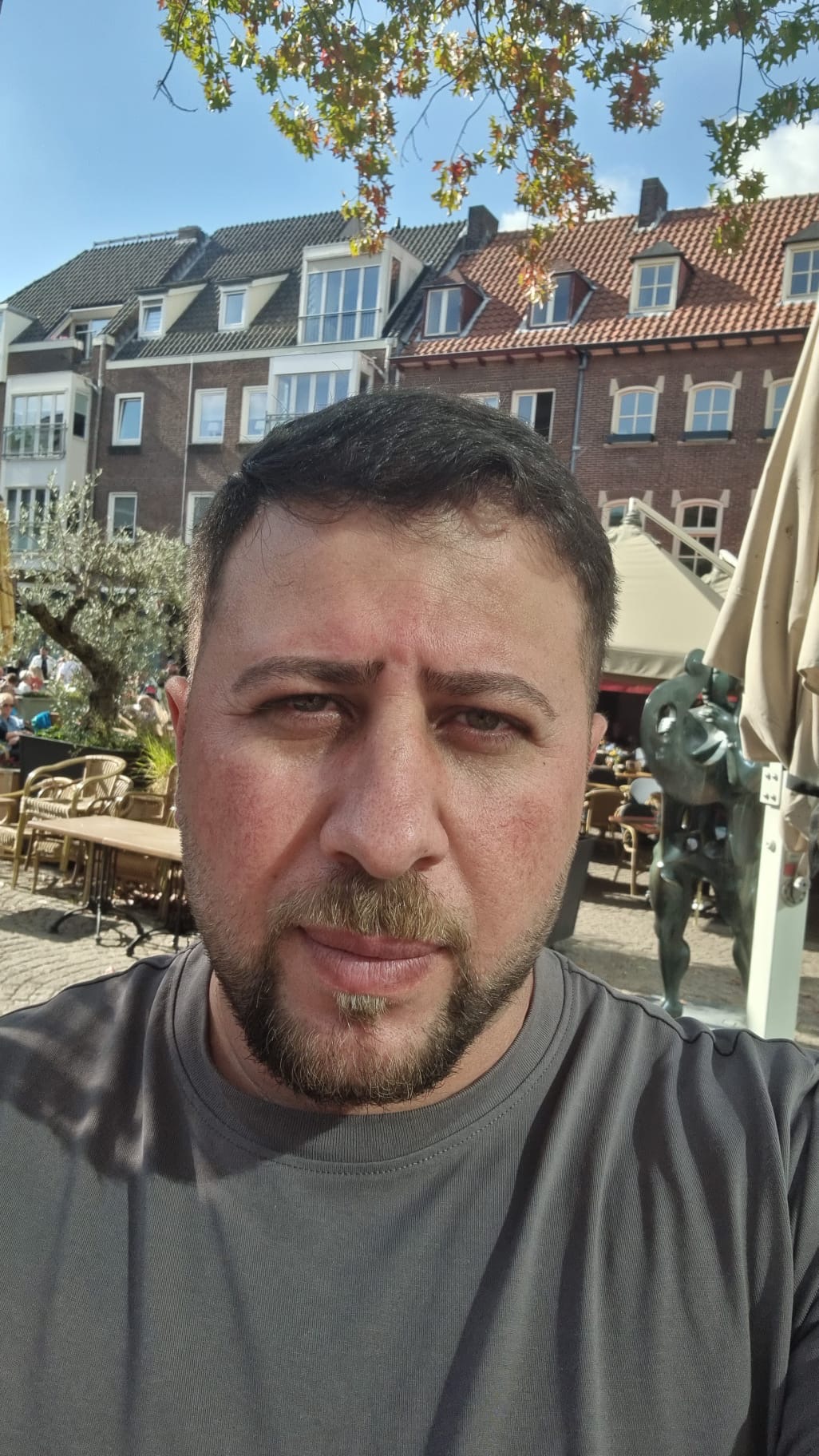 حالة 7 بعد زراعة الشعر