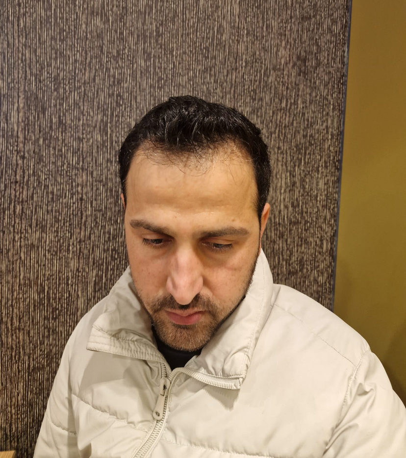 حالة 8 قبل زراعة الشعر