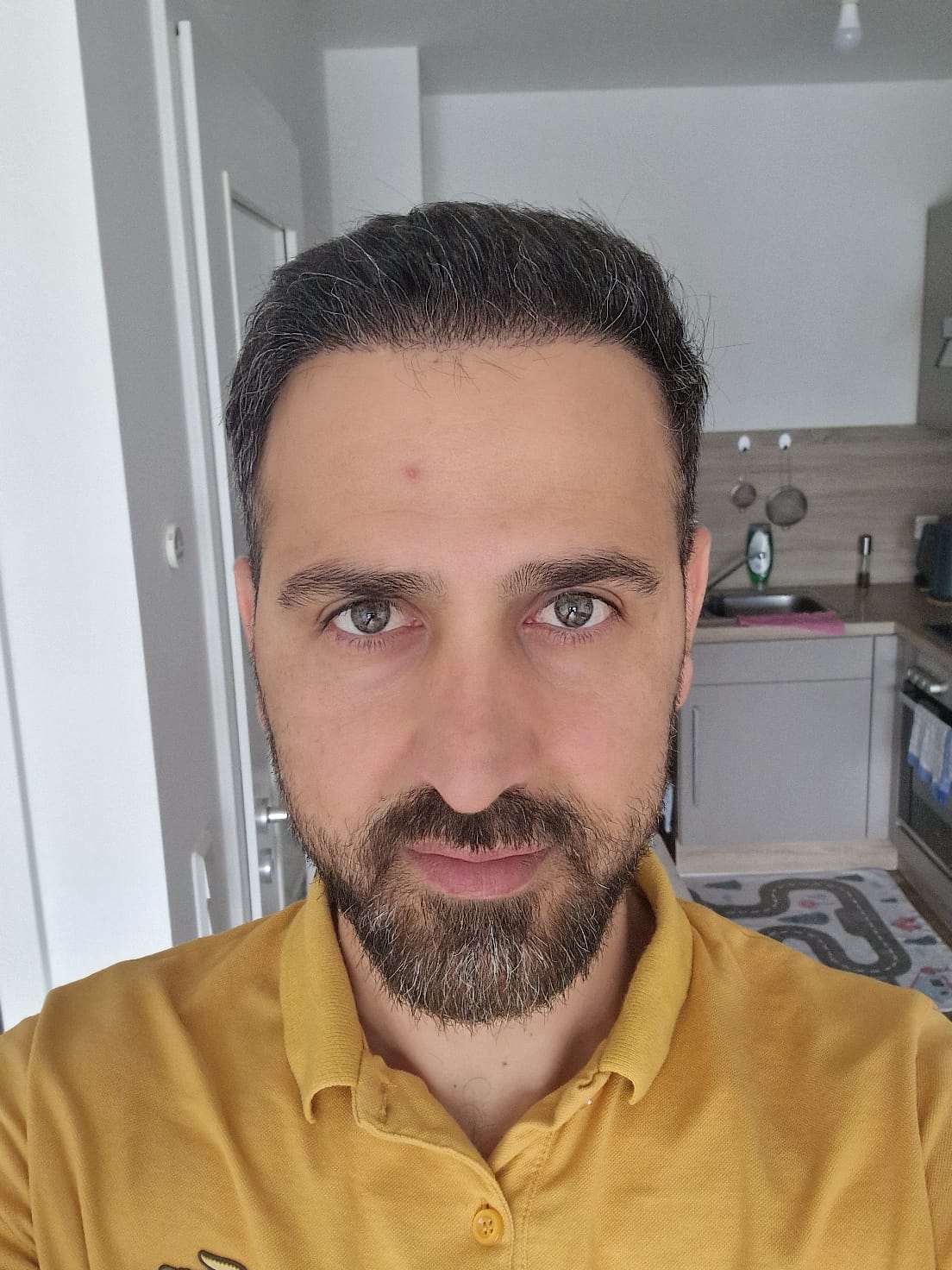 حالة 8 بعد زراعة الشعر