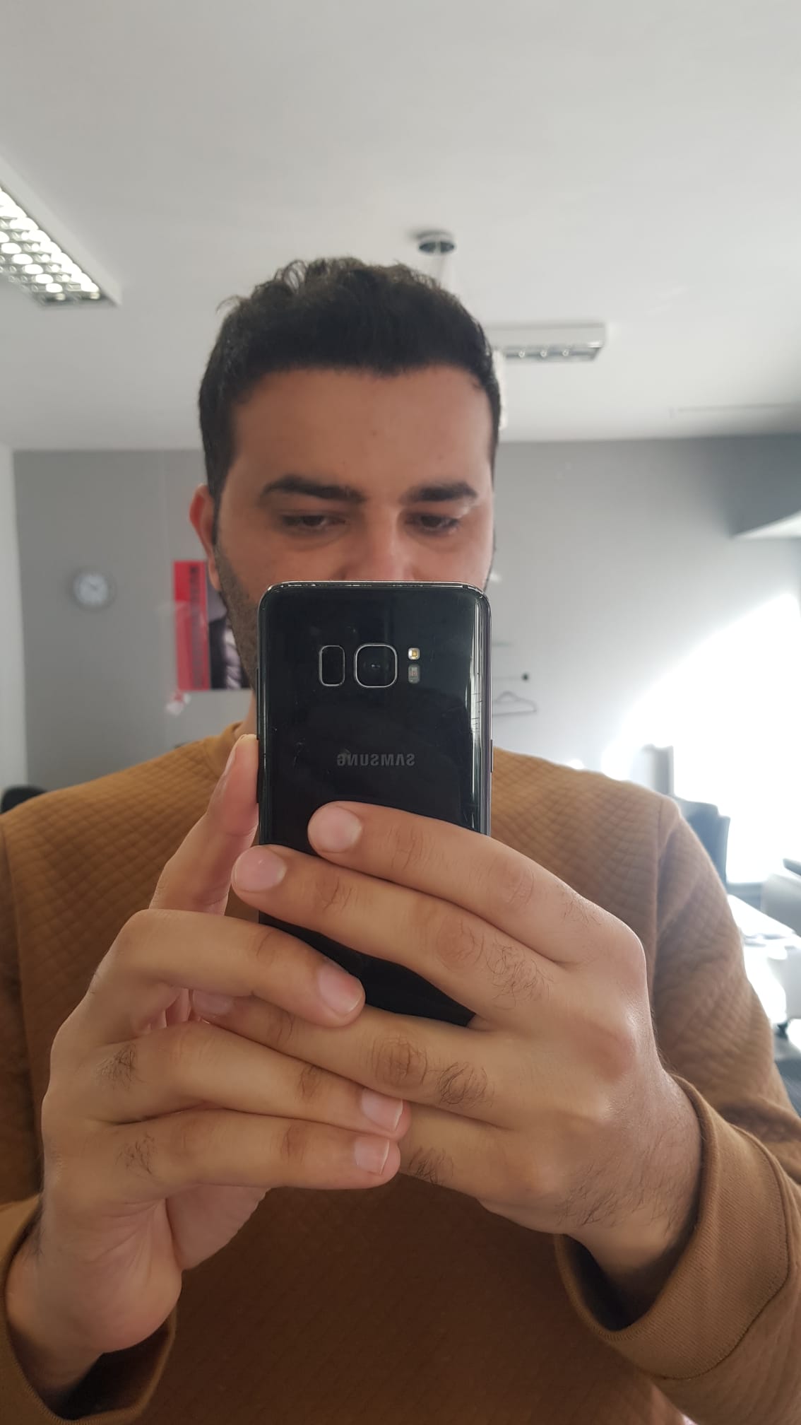 حالة 9 بعد زراعة الشعر