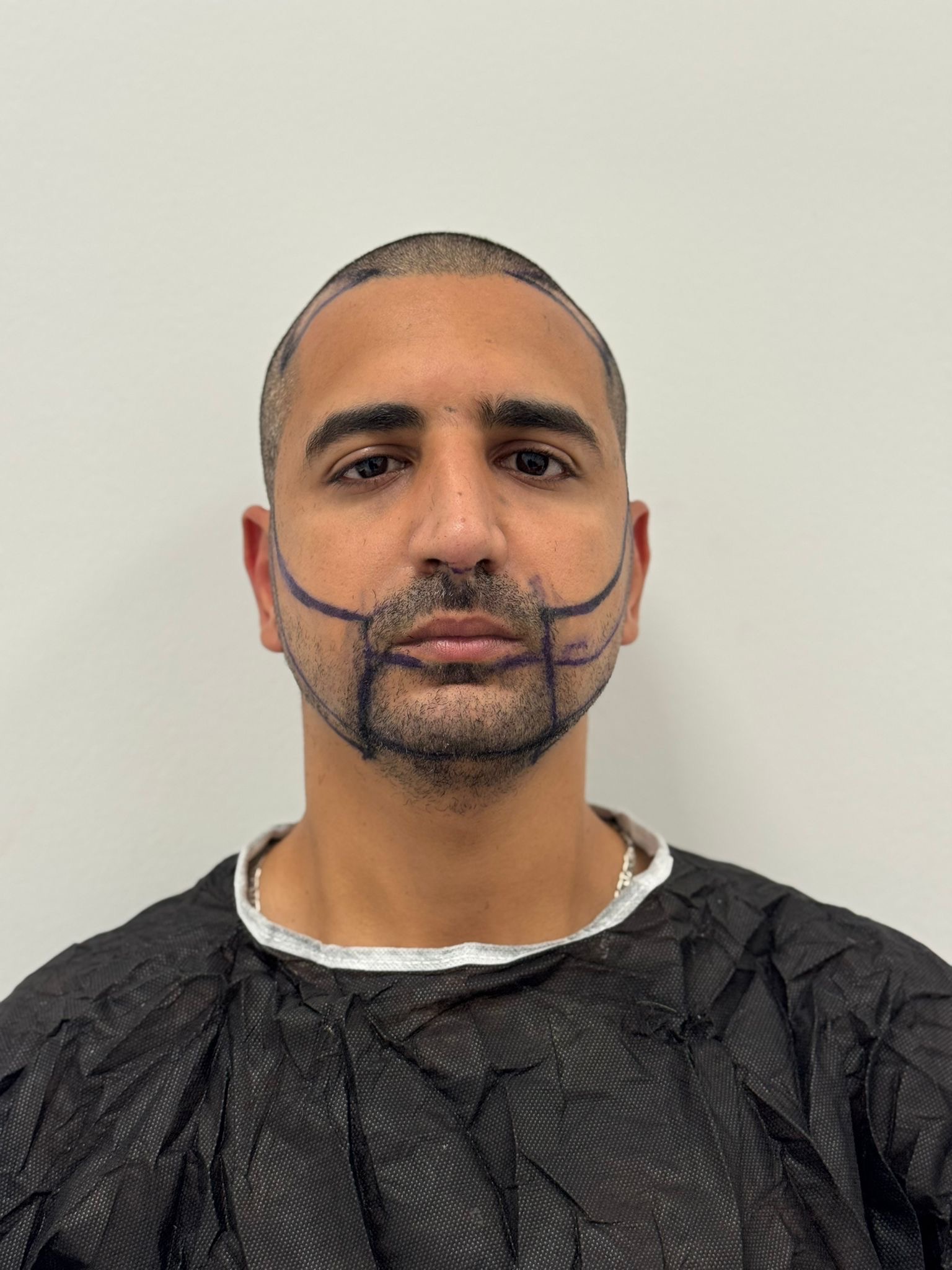 حالة 10 قبل زراعة الشعر