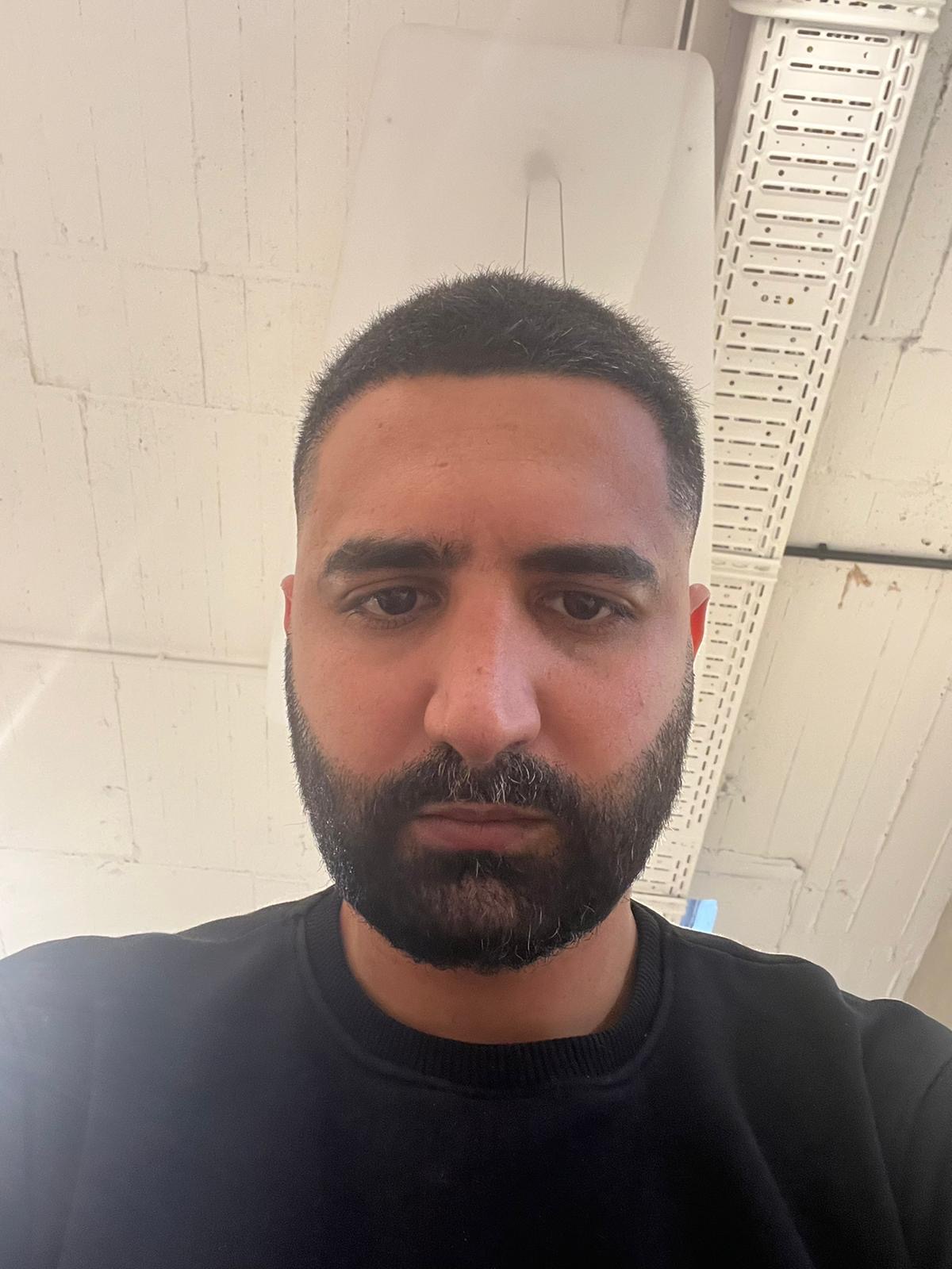حالة 10 بعد زراعة الشعر
