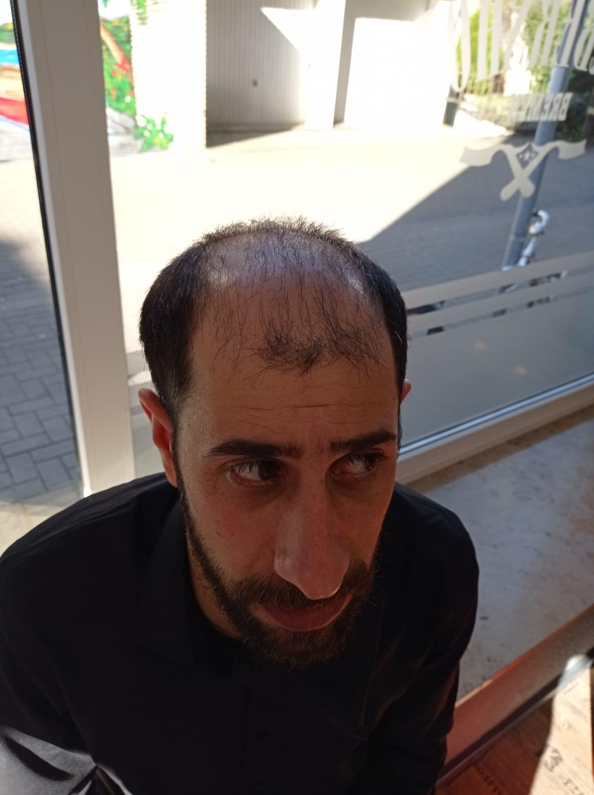 حالة 11 قبل زراعة الشعر