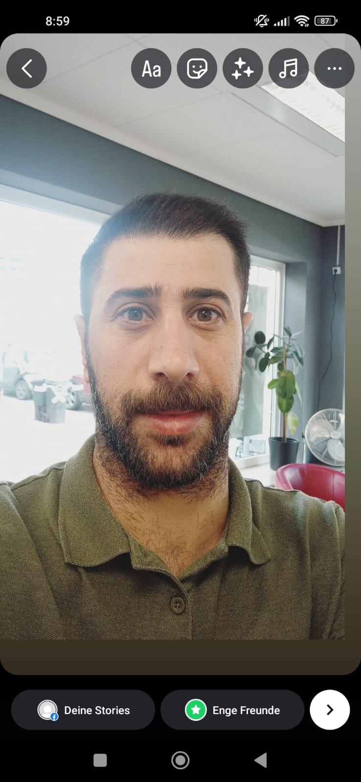 حالة 11 بعد زراعة الشعر