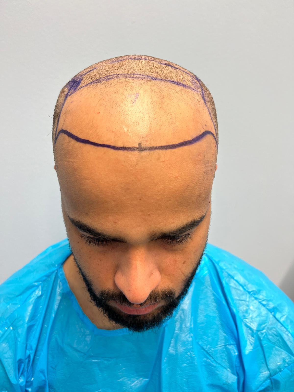 حالة 12 قبل زراعة الشعر