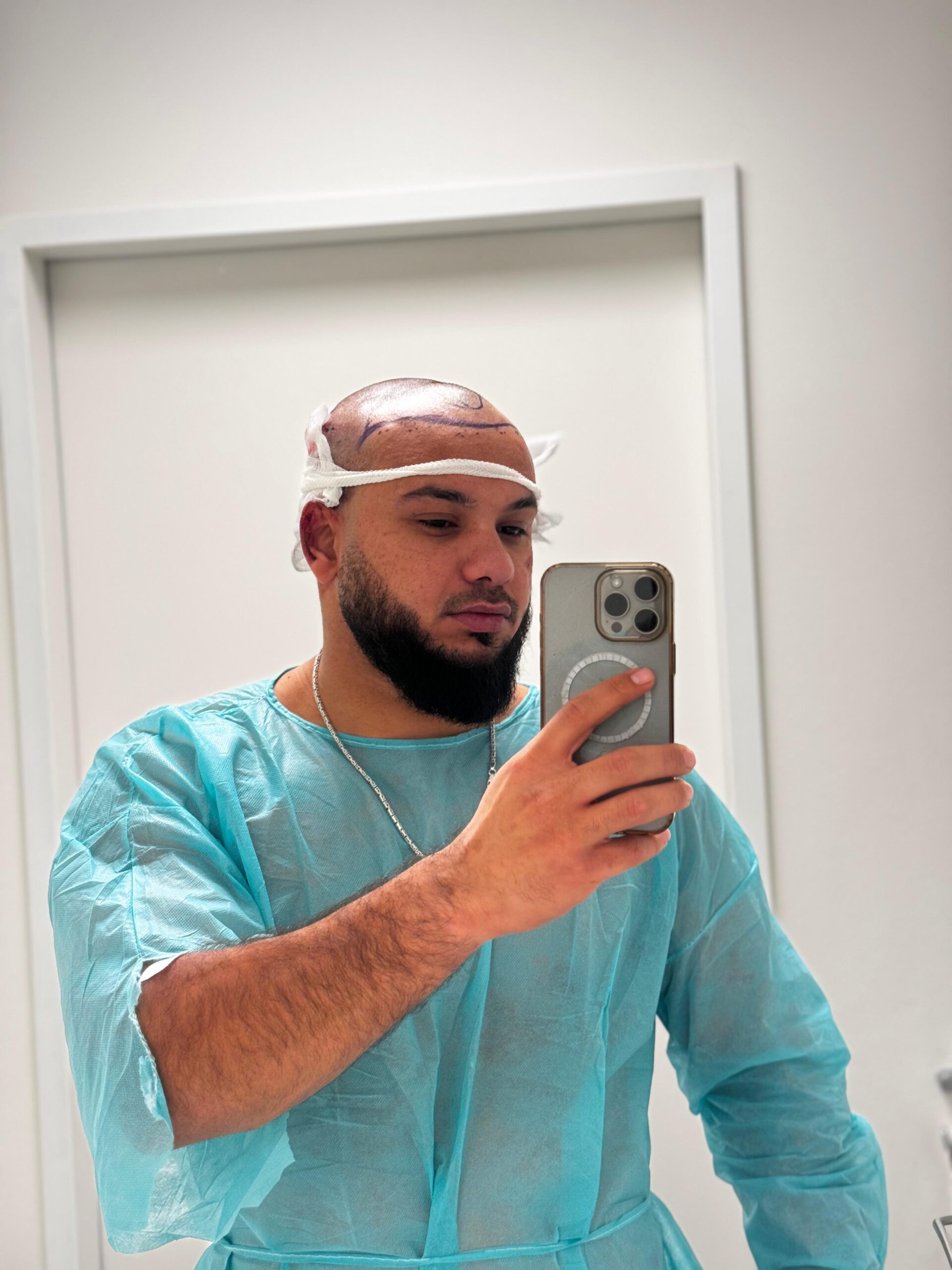 حالة 13 قبل زراعة الشعر