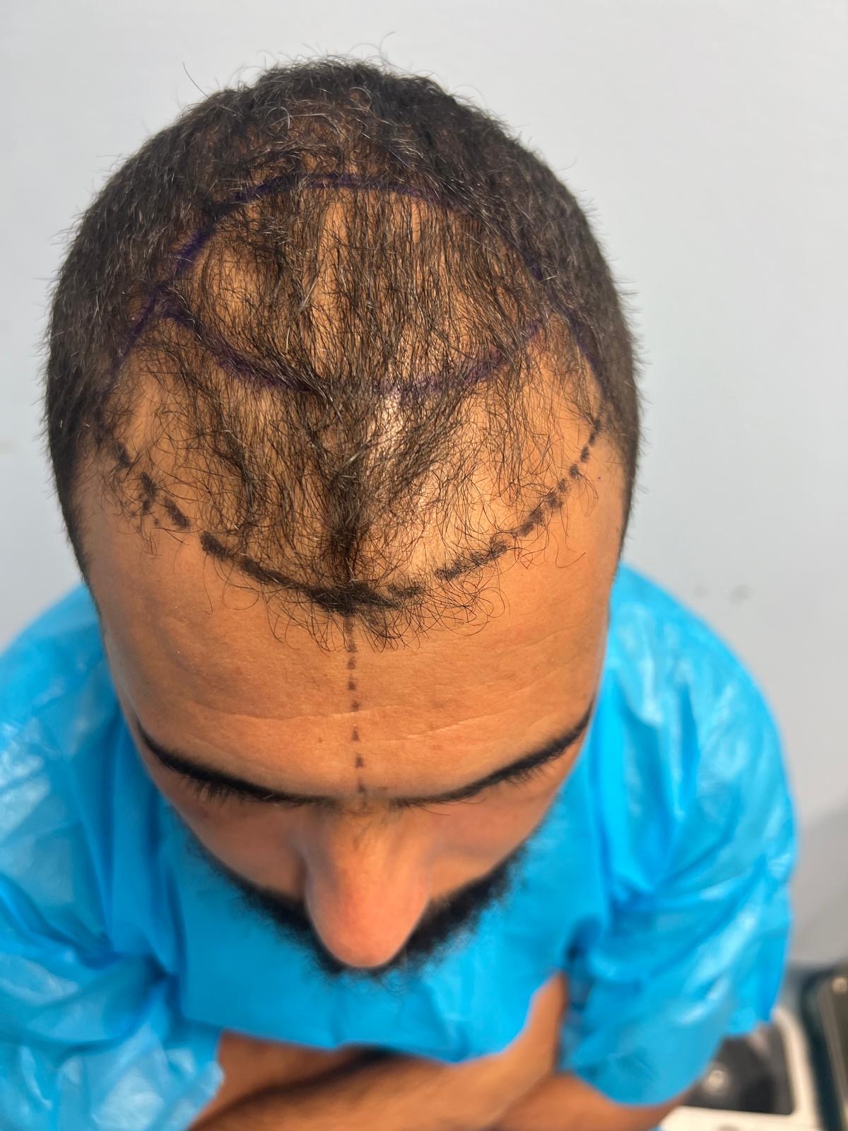 حالة 14 قبل زراعة الشعر