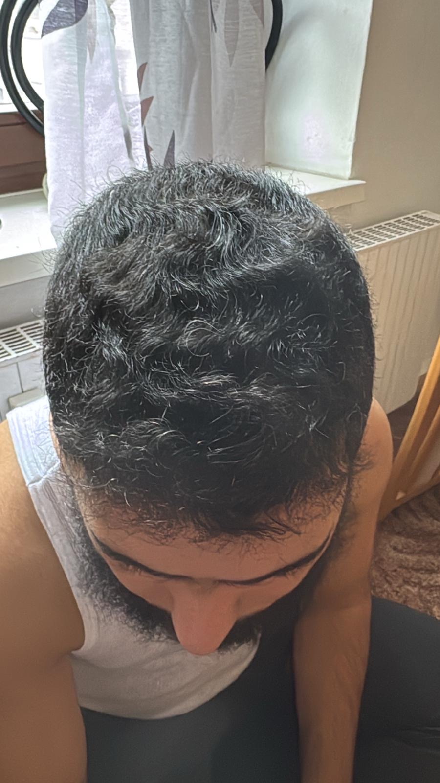 حالة 14 بعد زراعة الشعر
