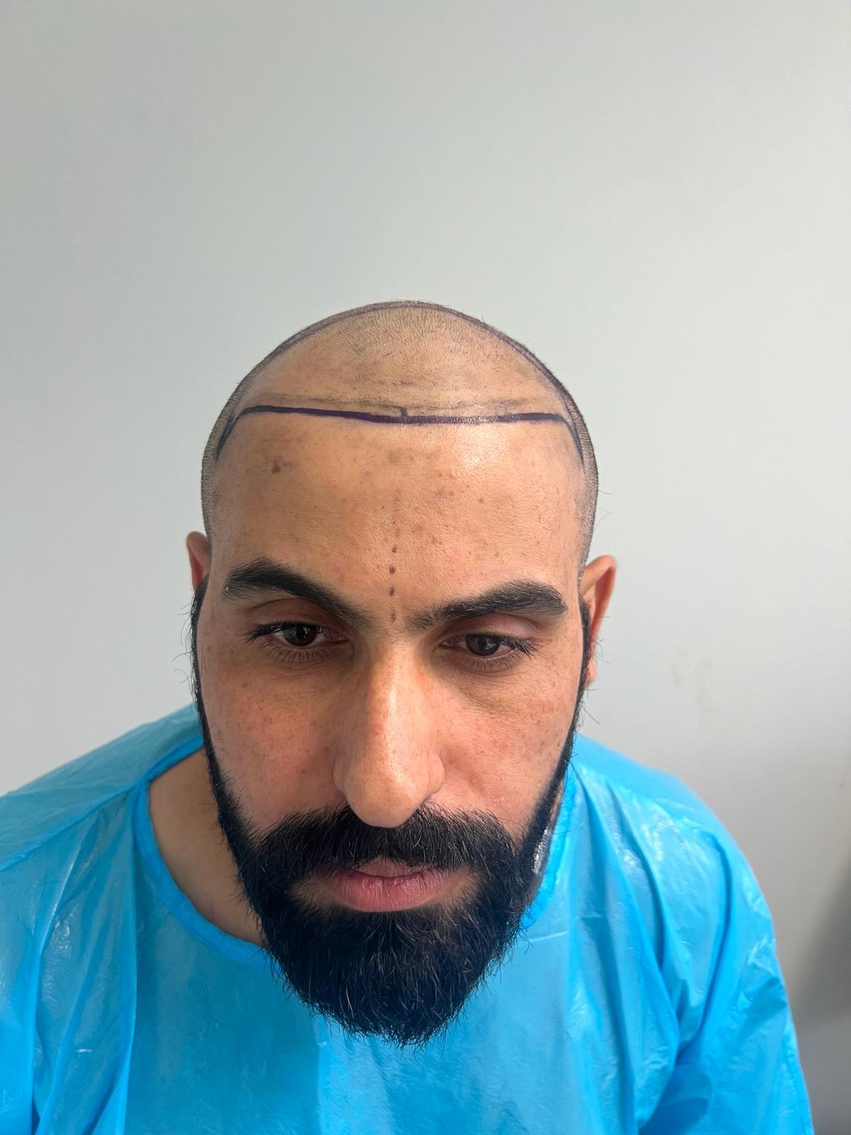 المريض قبل زراعة الشعر مع خط الجبهة المخطط