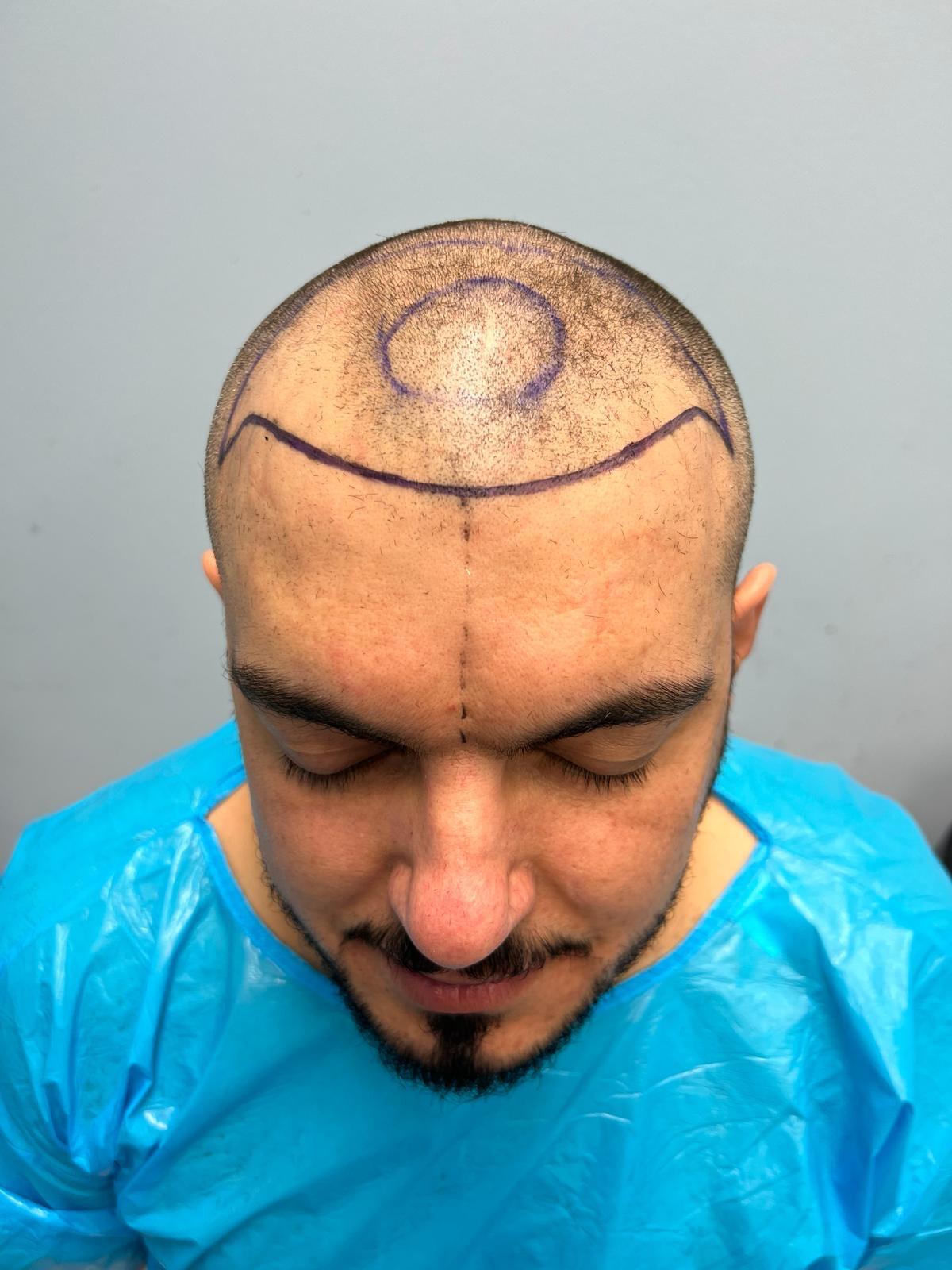 حالة 16 قبل زراعة الشعر